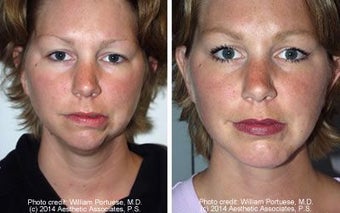 Neck Lift and Chin Implant before 91519