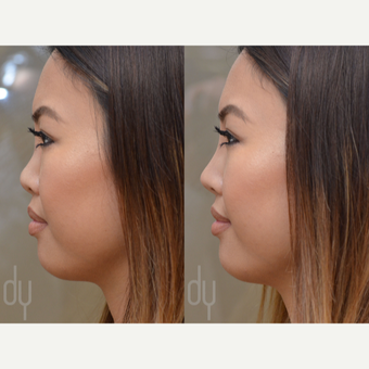 Non Surgical Rhinoplasty before 3322518