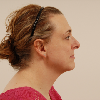 42 year old transgender woman underwent Facial Feminization Surgery. before 3109917