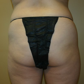 Brazilian Butt Lift before 3667473