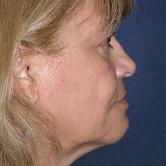 55-64 year old woman treated with Eye Bags Treatment before 3466633