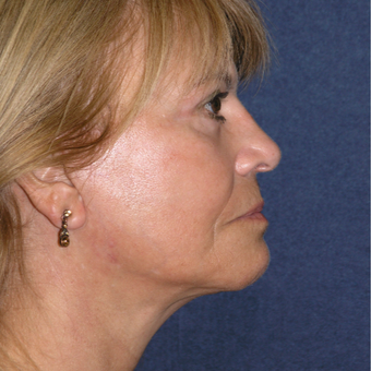 55-64 year old woman treated with Eye Bags Treatment after 3466633