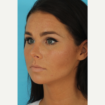 25-34 year old woman treated with Rhinoplasty after 3629205