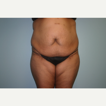 45-54 year old woman treated with Tummy Tuck before 3339408