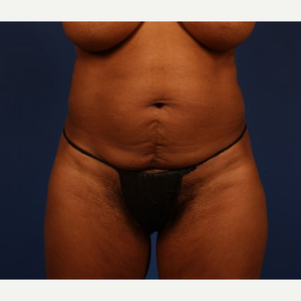 Tummy Tuck before 3743903