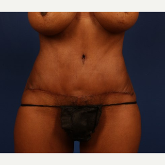 Tummy Tuck after 3743903