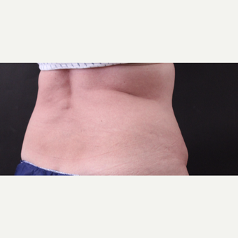 62 year old woman treated with CoolSculpting after 3221075
