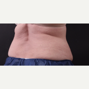 62 year old woman treated with CoolSculpting before 3221075