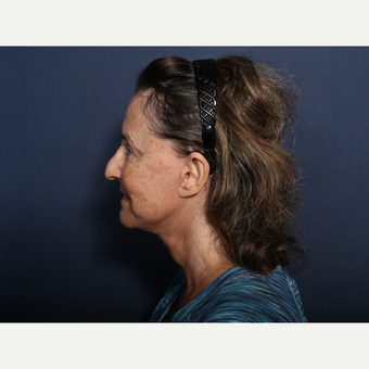 65-74 year old woman treated with Neck Lift (view 2 of 2) after 3260058
