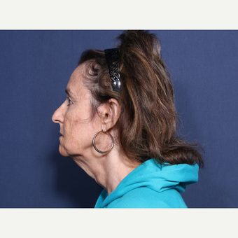 65-74 year old woman treated with Neck Lift (view 2 of 2) before 3260058