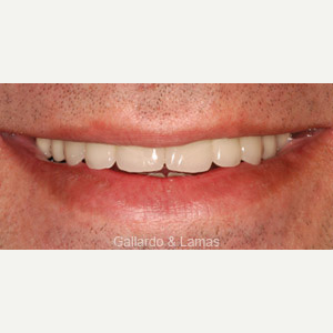 35-44 year old man treated with Dental Implants after 3093834