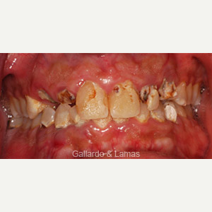 35-44 year old man treated with Dental Implants before 3093834
