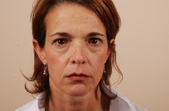 44 Year Old Female Treated with Youthenizing of the face! - Sculptra® Injections before 1114469