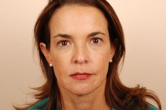 44 Year Old Female Treated with Youthenizing of the face! - Sculptra® Injections after 1114469