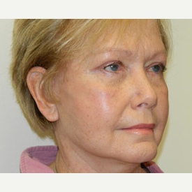 55-64 year old woman treated with Mini Lift and 4-Lid Blepharoplasty after 3264923