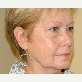 55-64 year old woman treated with Mini Lift and 4-Lid Blepharoplasty before 3264923