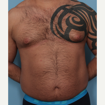 35-44 year old man treated with Fat Transfer before 3589524