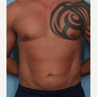 35-44 year old man treated with Fat Transfer after 3589524