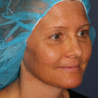 42 year old woman treated with Fraxel Dual Laser for melasma one time before 3616947