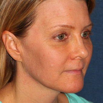 42 year old woman treated with Fraxel Dual Laser for melasma one time after 3616947