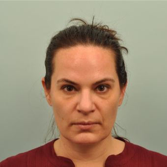 35-44 year old woman treated with Radiesse before 3241534