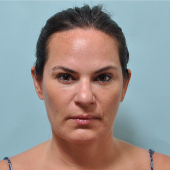 35-44 year old woman treated with Radiesse after 3241534