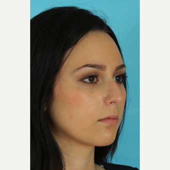 18-24 year old woman treated with Rhinoplasty before 3618437