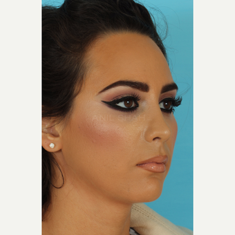 18-24 year old woman treated with Rhinoplasty after 3618437