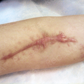 25-34 year old man treated with Scars Treatment before 3499142