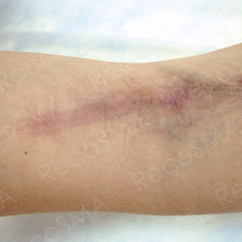 25-34 year old man treated with Scars Treatment after 3499142