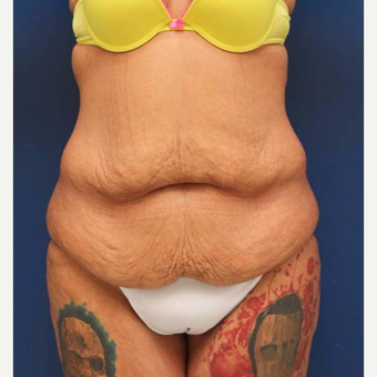 31 year old female, 100 pound weight loss with diet and exercise, had an abdominoplasty (tummy tuck) before 3814747