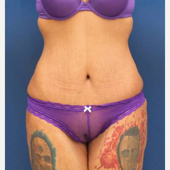 31 year old female, 100 pound weight loss with diet and exercise, had an abdominoplasty (tummy tuck) after 3814747