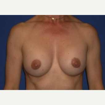 45-54 year old woman treated with Breast Augmentation after 3220042