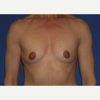 45-54 year old woman treated with Breast Augmentation before 3220042
