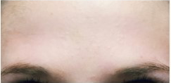 25-34 year old woman treated with Botox after 3332745