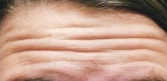 25-34 year old woman treated with Botox before 3332745