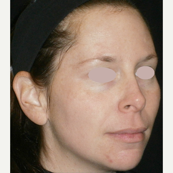 25-34 year old woman treated with multiple IPL treatments after 3089392