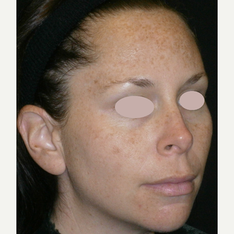 25-34 year old woman treated with multiple IPL treatments before 3089392