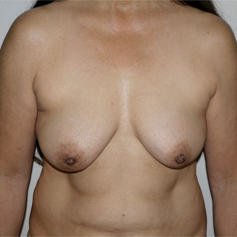 55-64 year old woman treated with Breast Lift with Implants before 3191568