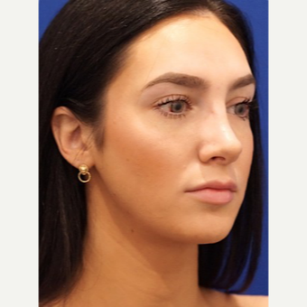 25-34 year old woman treated with Rhinoplasty after 3034401