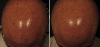 35-44 year old man treated with Chemical Peel & Hydroquinone Pads before 2093827