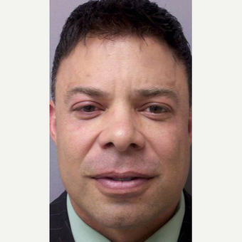 Man treated with Juvederm before 1807649