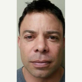 Man treated with Juvederm after 1807649