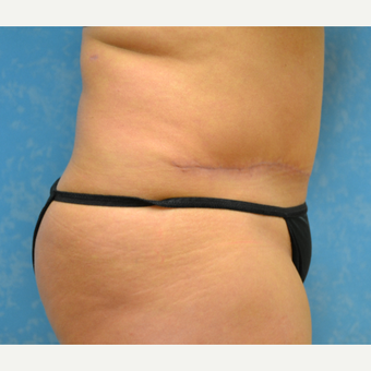 35-44 year old woman treated with Tummy Tuck after 3731945