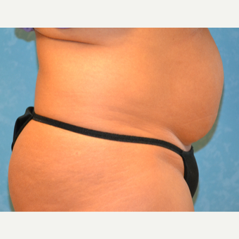35-44 year old woman treated with Tummy Tuck before 3731945
