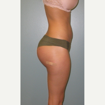 Buttock Augmentation with Implants after 3852916