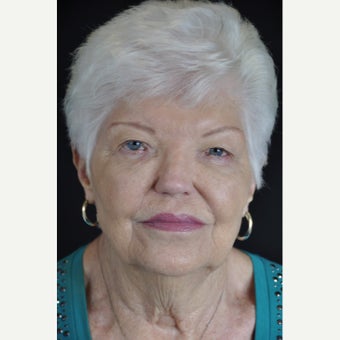 75 year-old woman treated with Facelift and Blepharoplasty. before 1973944