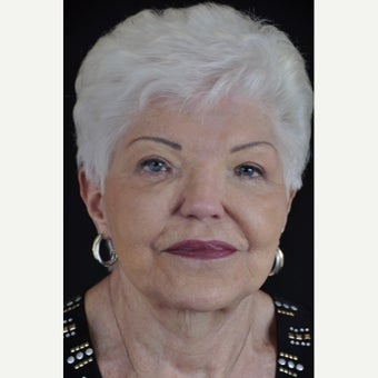 75 year-old woman treated with Facelift and Blepharoplasty. after 1973944