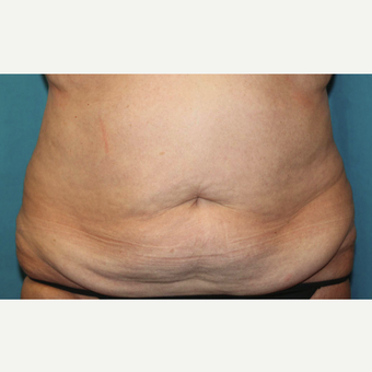 55-64 year old woman treated with CoolSculpting before 3483199
