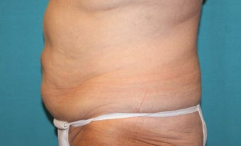 55-64 year old woman treated with CoolSculpting 3483199